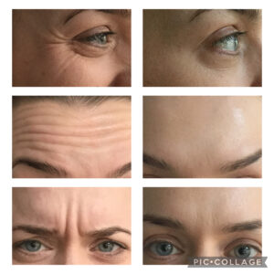 Amanda Kemp Aesthetics Glasgow Wrinkle Reduction Treatment