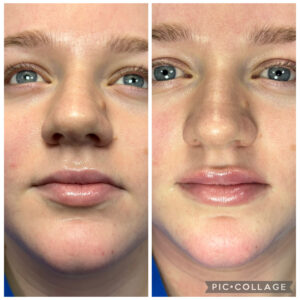 Amanda Kemp Aesthetics Glasgow Wrinkle Dermal Fillers Treatment