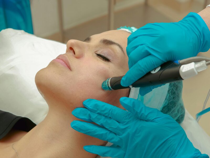 Microneedling Amanda Kemp Aesthetics Glasgow